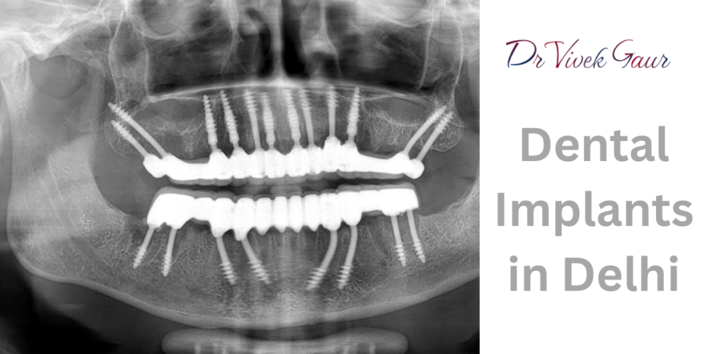Best dental implants in Delhi