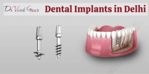 Best dental implants in Delhi