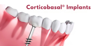 Corticobasal dental implants in India