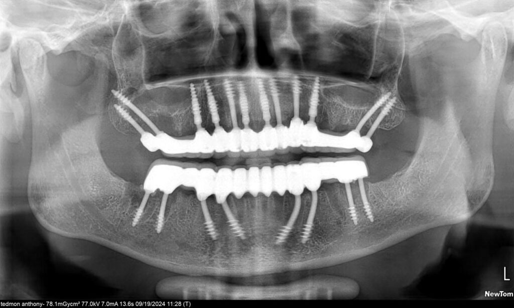 full mouth dental implants same-day procedure