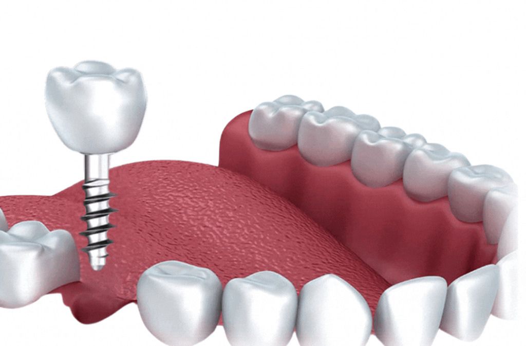 Corticobasal implants Ghaziabad Dr Vivek Gaur