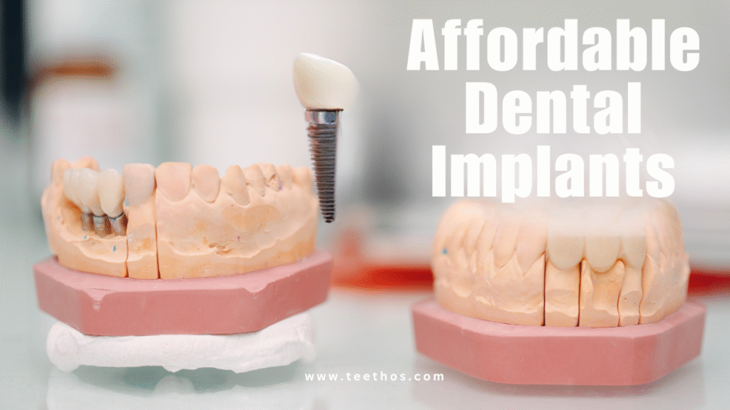 Affordable dental implants in Delhi