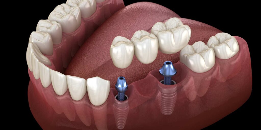 dental implant surgery