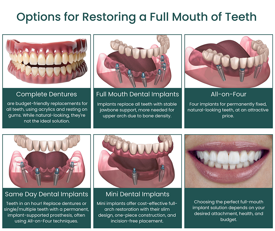 Full mouth dental implants near me