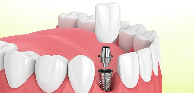 Affordable full mouth dental implants in Delhi NCR