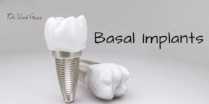 Basal Cortical Dental Implants