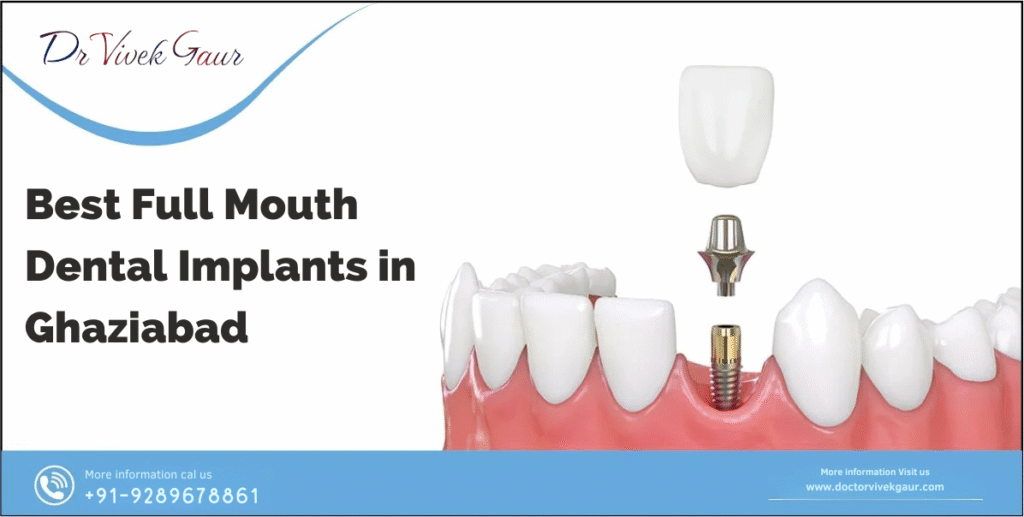 full-mouth dental implants Ghaziabad