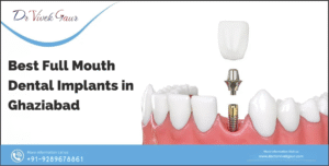 full-mouth dental implants Ghaziabad