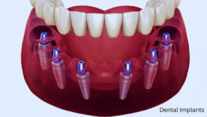 dental implants