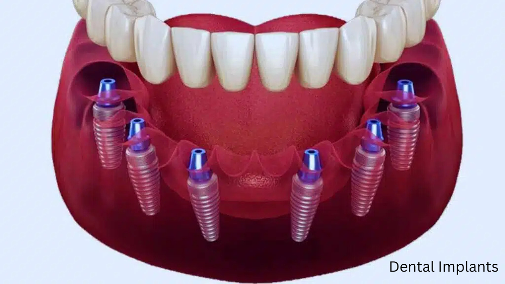 dental implants