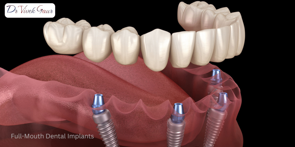 full-mouth dental implants India