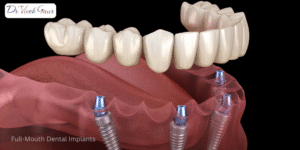 full-mouth dental implants India
