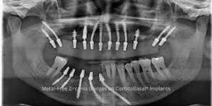 Best Dental Implant Doctor Delhi