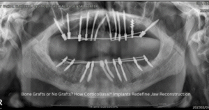 CorticoBasal implants immediate loading dental implants Ghaziabad