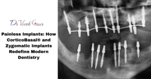 CorticoBasal implant placement X-ray showing basal jaw stabilization, zygomatic dental implant