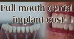 full mouth dental implants treatment
