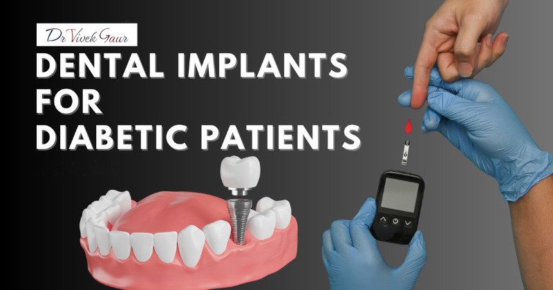 full mouth implant surgeon