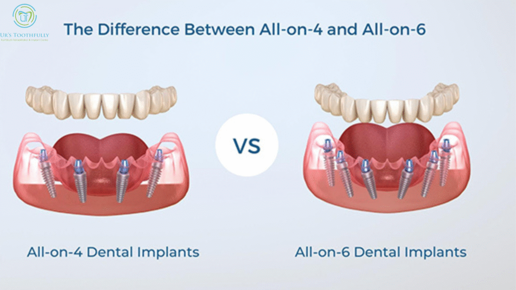 basal implant dental restoration Ghaziabad clinic