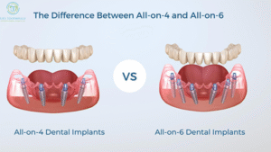 basal implant dental restoration Ghaziabad clinic
